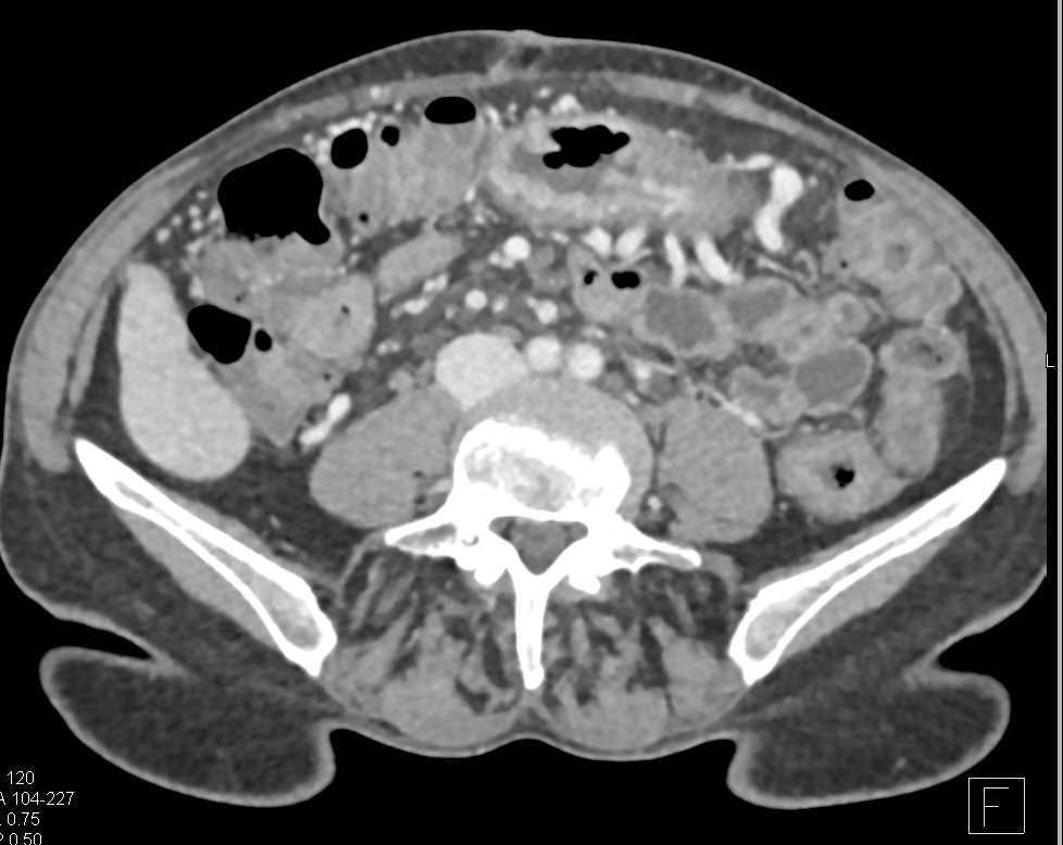 Stent in Superior Mesenteric Vein (SMV) That is Occluded - CTisus CT Scan