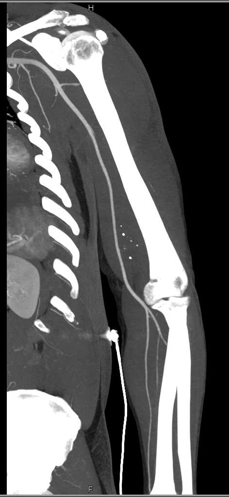 GSW to Arm Without Vascular Injury - CTisus CT Scan