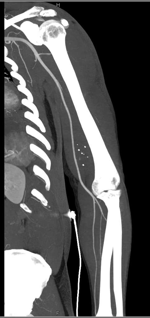 GSW to Arm Without Vascular Injury and Seen With Bon Removal - CTisus CT Scan