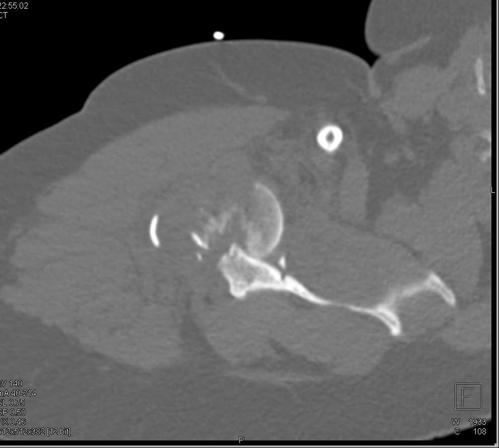 Fracture/Dislocation of Humerus and Glenoid Process - CTisus CT Scan