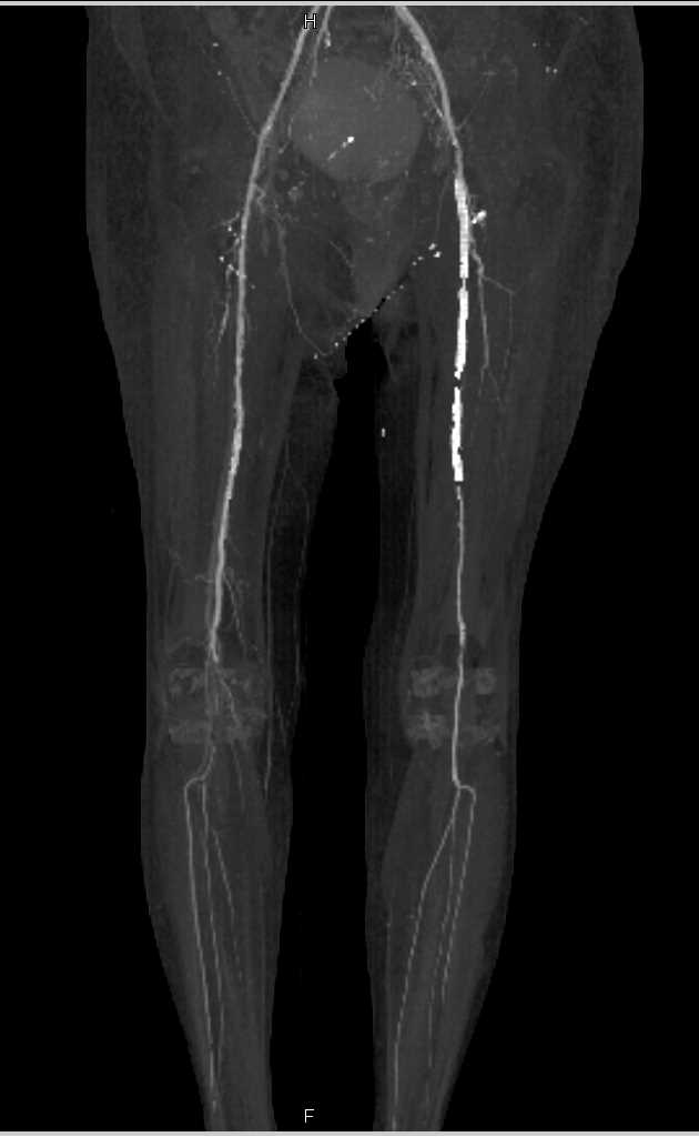 CTA Runoff with Peripheral Vascular Disease and Stents in the Left Superficial Femoral Artery (SFA) - CTisus CT Scan