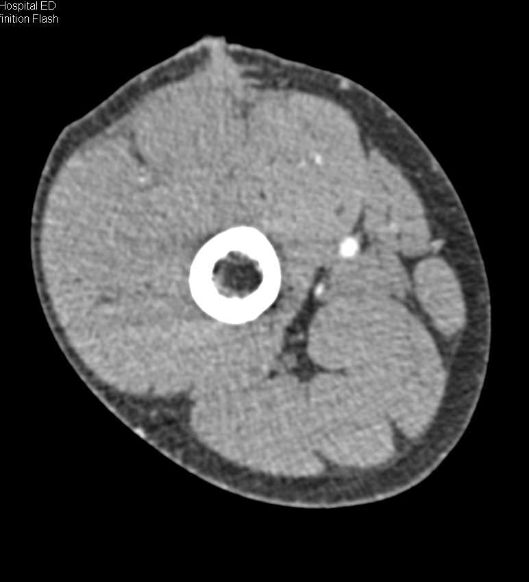 CTA Thigh with Stab Wound and Subtle Bleed off the Superficial Femoral Artery (SFA) - CTisus CT Scan