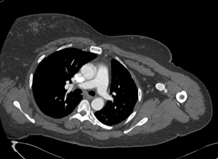 Arteriovenous (AV) Fistulae with Graft Left Arm and Axilla - CTisus CT Scan