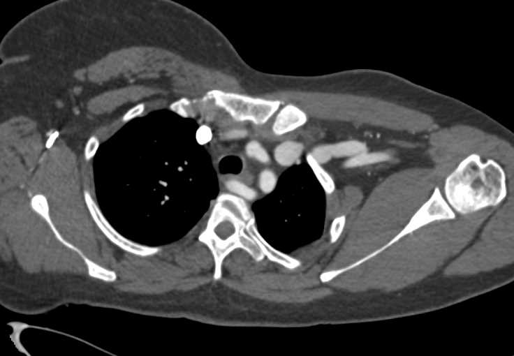 Arteriovenous (AV) Fistulae with Graft Left Arm and Axilla - CTisus CT Scan