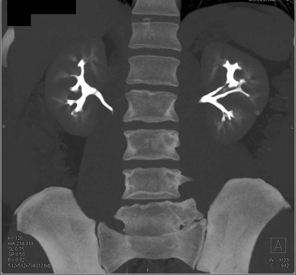 Aortic Dissection Extends down to the Renal Arteries - CTisus CT Scan