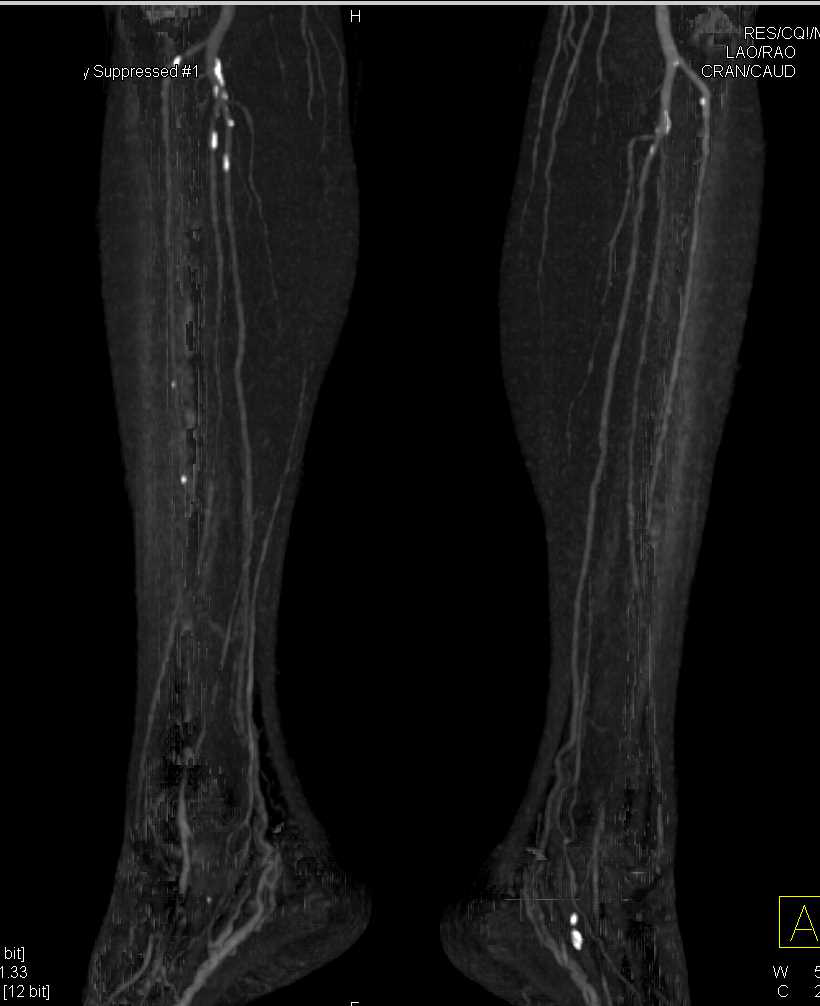 Peripheral Vascular Disease (PVD) with Occlusion of the Left Common Iliac Artery - CTisus CT Scan