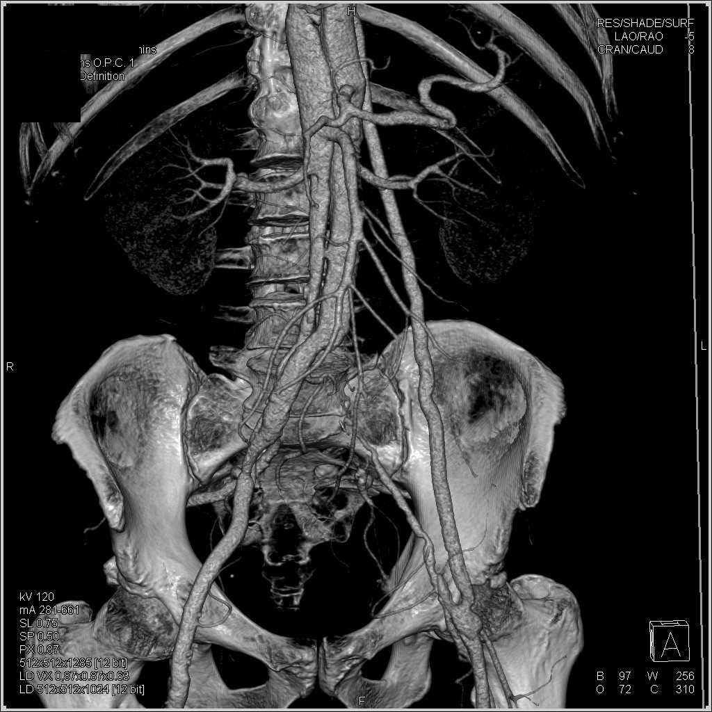 Multiple Dissections Including the Left Subclavian Artery and the Abdominal Aorta - CTisus CT Scan