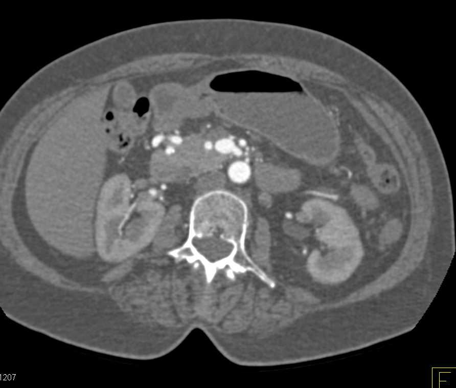 celiac-stenosis-with-flow-through-the-gastroduodenal-artery-gda-which