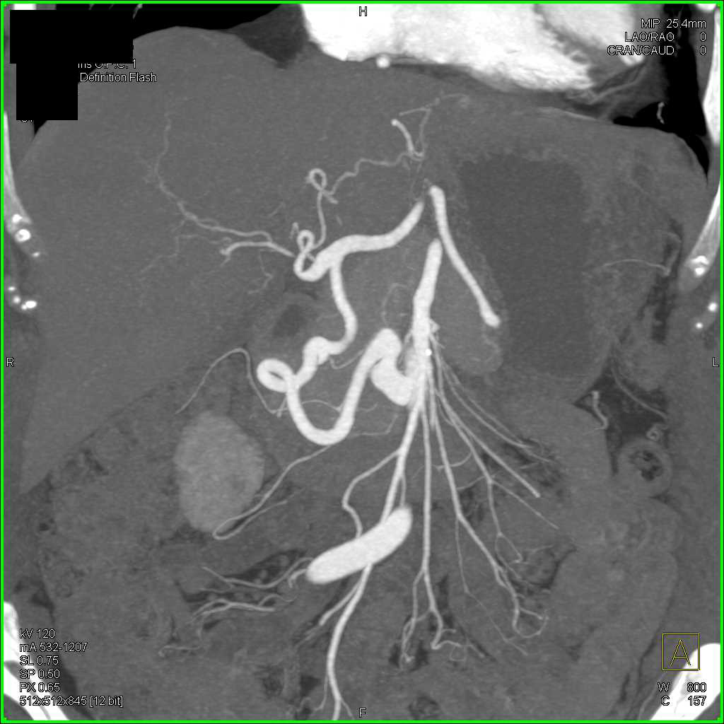 Celiac Stenosis with Flow Through the Gastroduodenal Artery (GDA) Which is Dilated - CTisus CT Scan