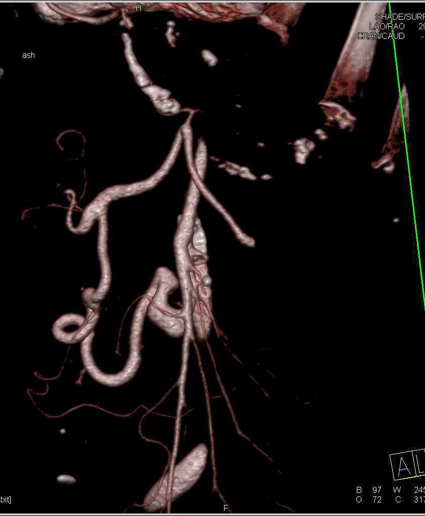 Celiac Stenosis (Occlusion) with Flow Through the Gastroduodenal Artery (GDA) Which is Dilated - CTisus CT Scan