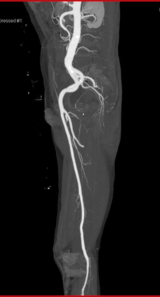 Left Atrial Thrombus and Pulmonary Embolism (PE) and Occlusion of the Left Superficial Femoral Artery (SFA) - CTisus CT Scan