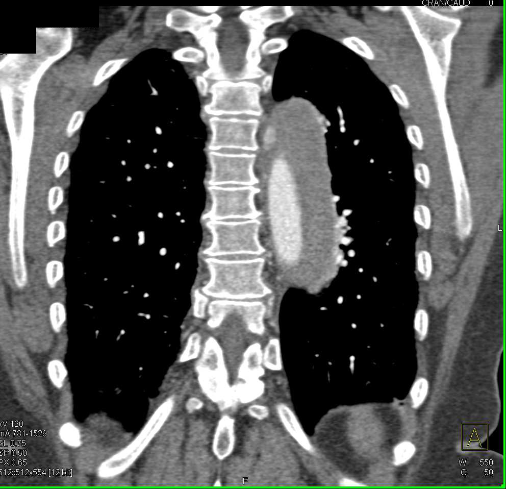 Intramural Hematoma Thoracic Aorta - CTisus CT Scan