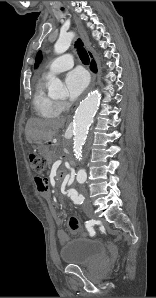 Endovascular Stent with Type 2 Endoleak - CTisus CT Scan