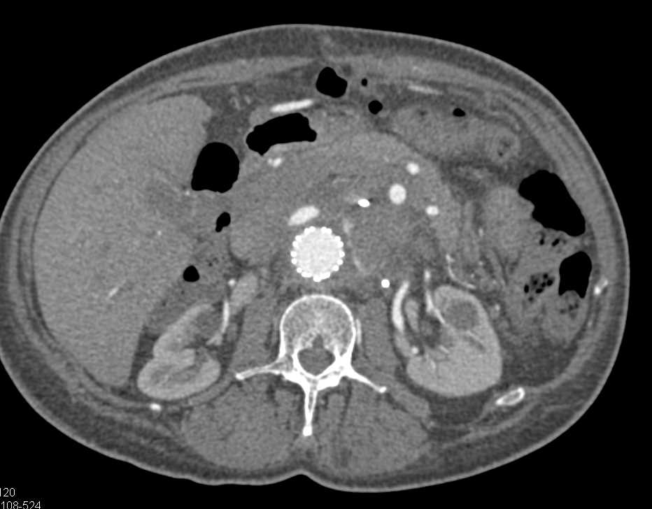 Endoleak in Patient with Graft and Multiple Collaterals - CTisus CT Scan