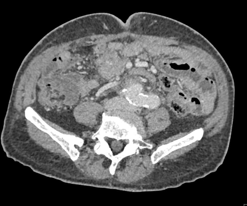 Endoleak in Patient with Graft and Multiple Collaterals - CTisus CT Scan