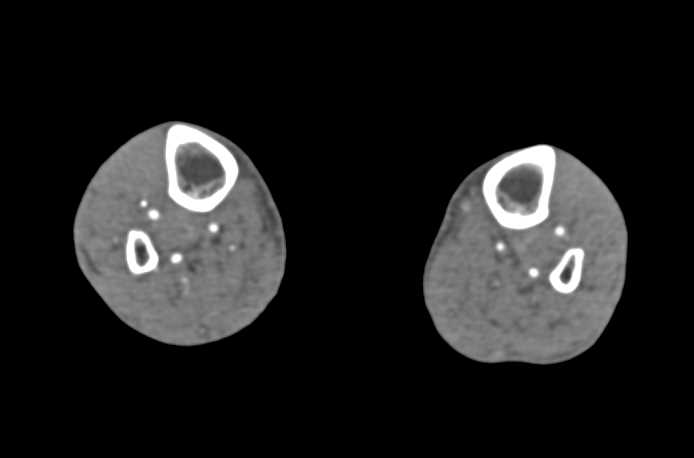 Extensive Peripheral Vascular Disease - CTisus CT Scan