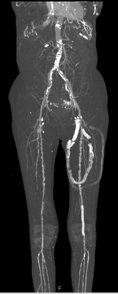 Occluded Arteriovenous (AV) Shunts in the Left Thigh in Patient with End Stage Renal Disease (ESRD) and Peripheral Vascular Disease (PVD) - CTisus CT Scan