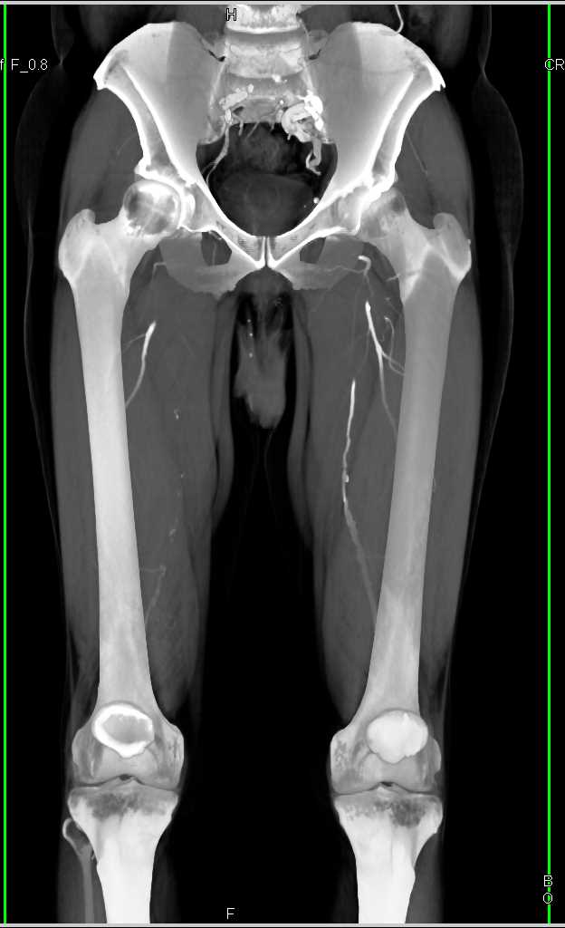 Left Superficial Femoral Artery (SFA) Occlusion - CTisus CT Scan