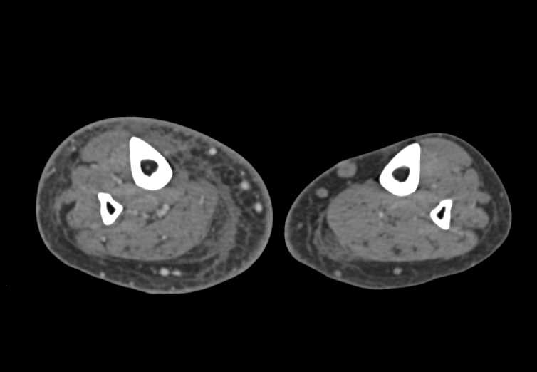 Cellulitis Right Calf with Increased and Early Venous Flow - CTisus CT Scan