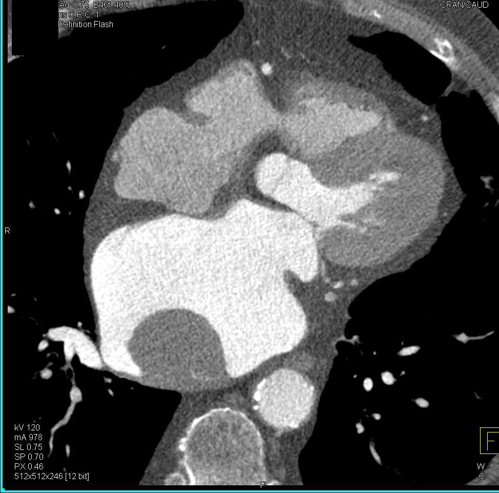 Left Atrial Myxoma - CTisus CT Scan