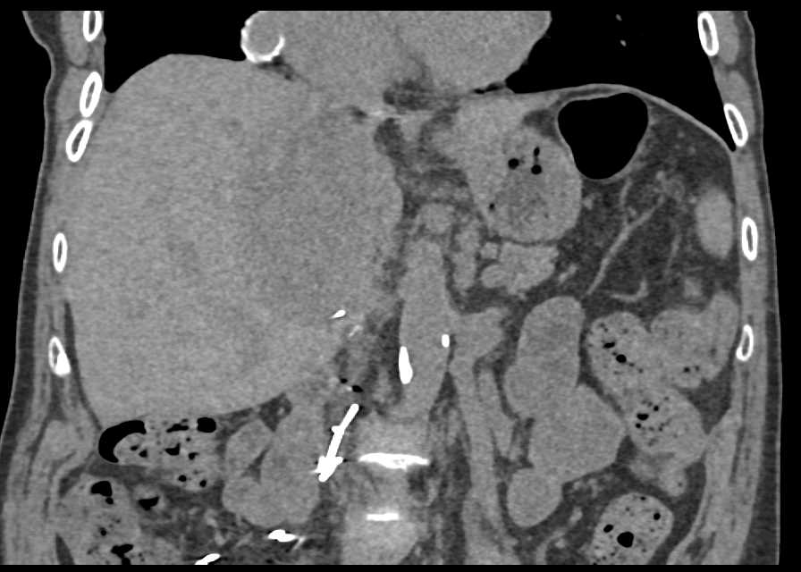 Inferior Vena Cava (IVC) Involvement of Renal Cell Carcinoma with Vascular Bypass - CTisus CT Scan