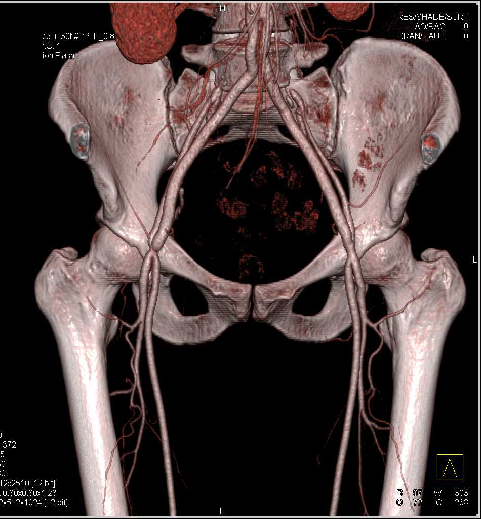 Vascular Graft to the Superficial Femoral Artery (SFA) - CTisus CT Scan