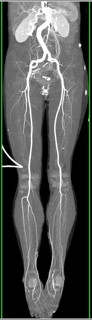 CTA Runoff with Good Vascular Mapping - CTisus CT Scan