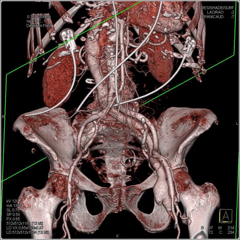 Arteriovenous (AV) Fistulae Left Groin with Early Inferior Vena Cava (IVC) flow - CTisus CT Scan