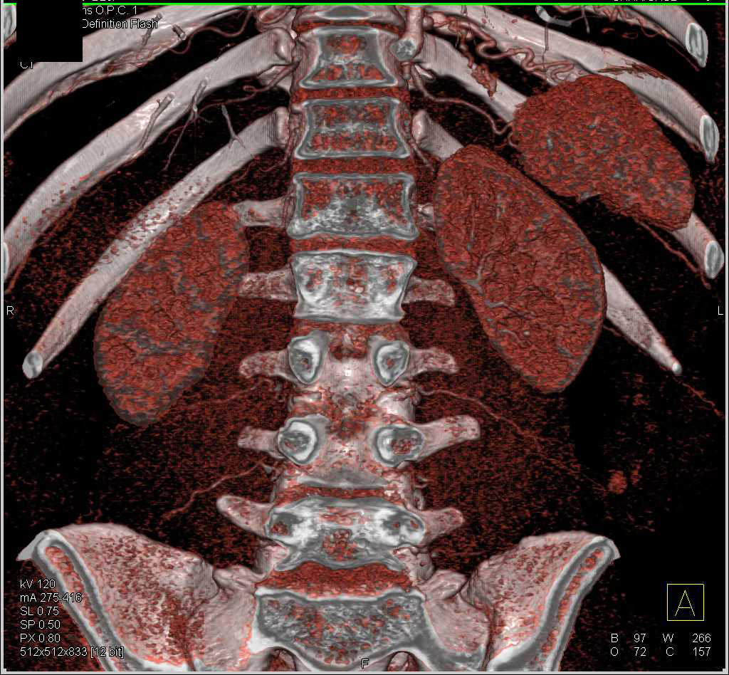 Annomalous Artery off the Celiac Artery - CTisus CT Scan