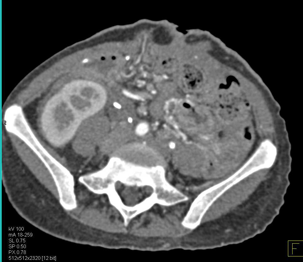 Patent Fem-Fem Bypass in Patient with Occlusion of the Left Common Iliac Artery - CTisus CT Scan