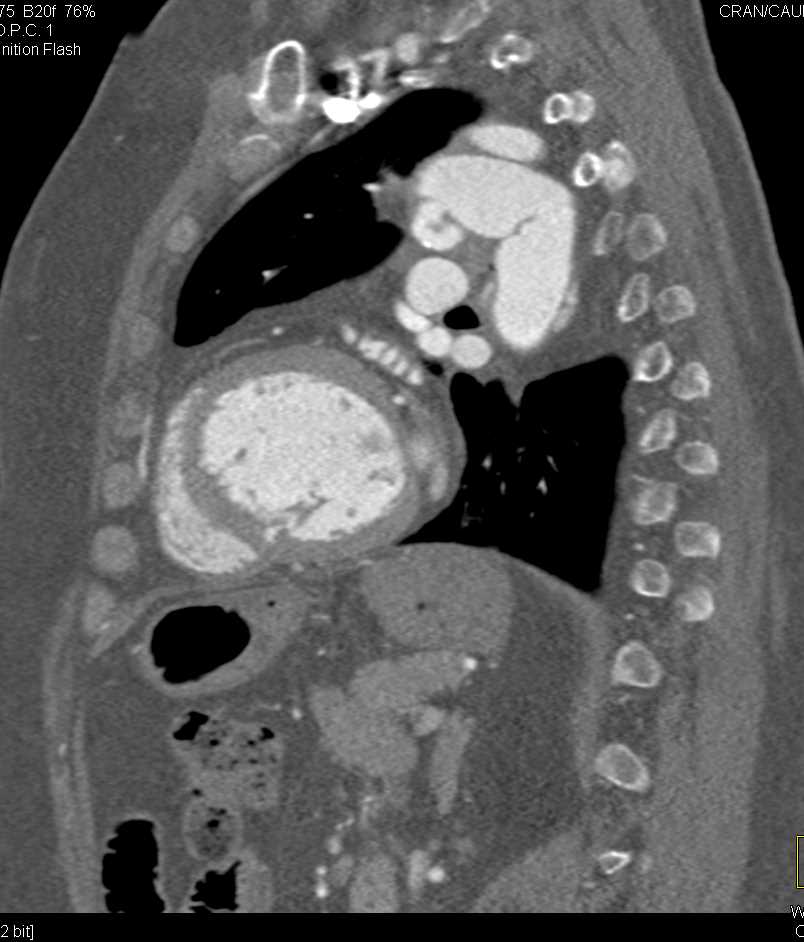 Arch Repair with Re-Implanted Left Subclavian Artery - CTisus CT Scan