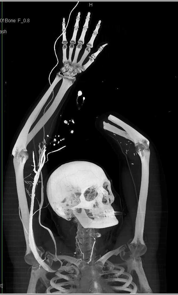 CTA for Reconstructive Surgery for Arm Prosthesis - CTisus CT Scan