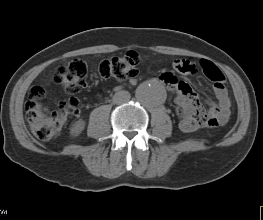 Infrarenal Aortic Aneurysm - CTisus CT Scan