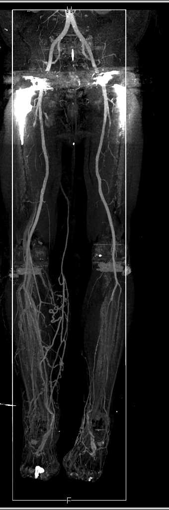 CTA Runoff with Good Vascular Mapping with Peripheral Vascular Disease (PVD) on Left and Cellulitis on the Right Side - CTisus CT Scan