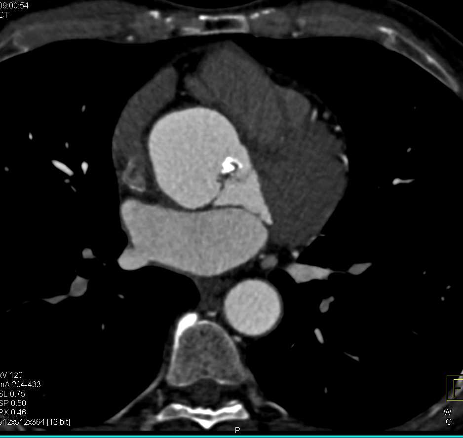 Aortic Stenosis with Calcified Bicuspid Aortic Valve - CTisus CT Scan