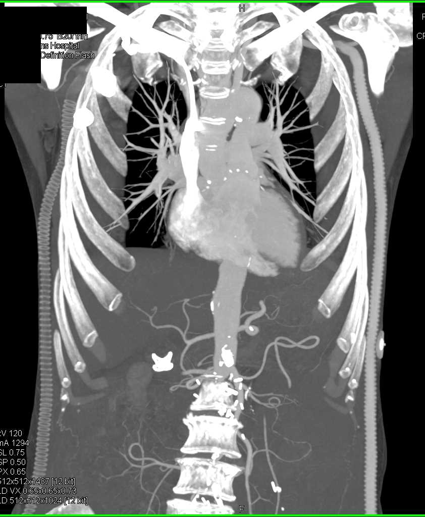 Right Axillary Fem Bypass Graft is Occluded and the Left Axillary-Fem Bypass is patent - CTisus CT Scan