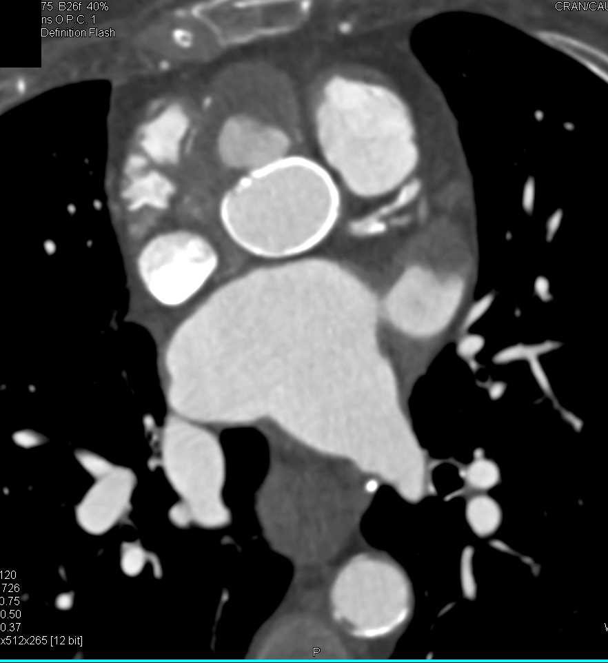 Pseudo-aneurysm of Aortic Root - CTisus CT Scan