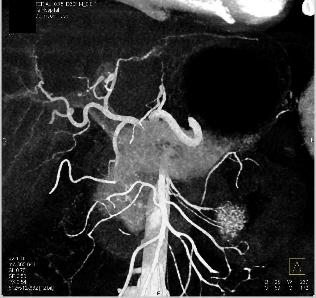 Classic Arterial Mapping of Celiac and Superior Mesenteric Artery (SMA) - CTisus CT Scan