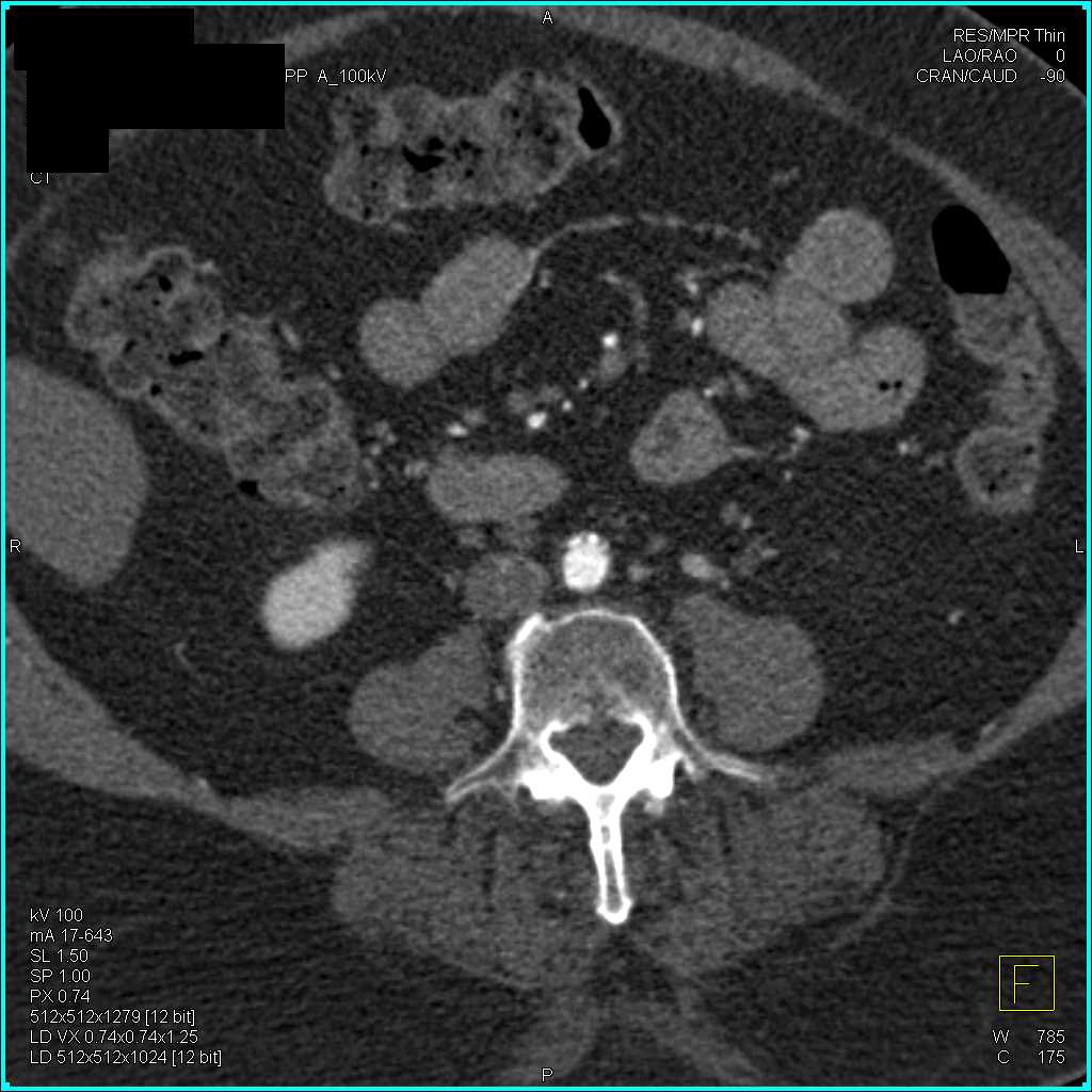 Occlusion of Stent in the Right Common Iliac Artery - CTisus CT Scan