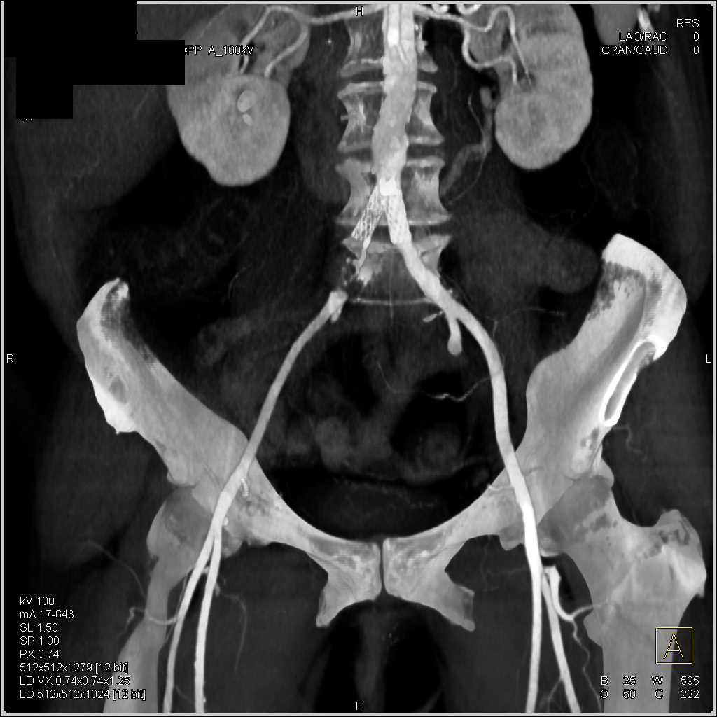 Occlusion of Stent in the Right Common Iliac Artery - Vascular Case