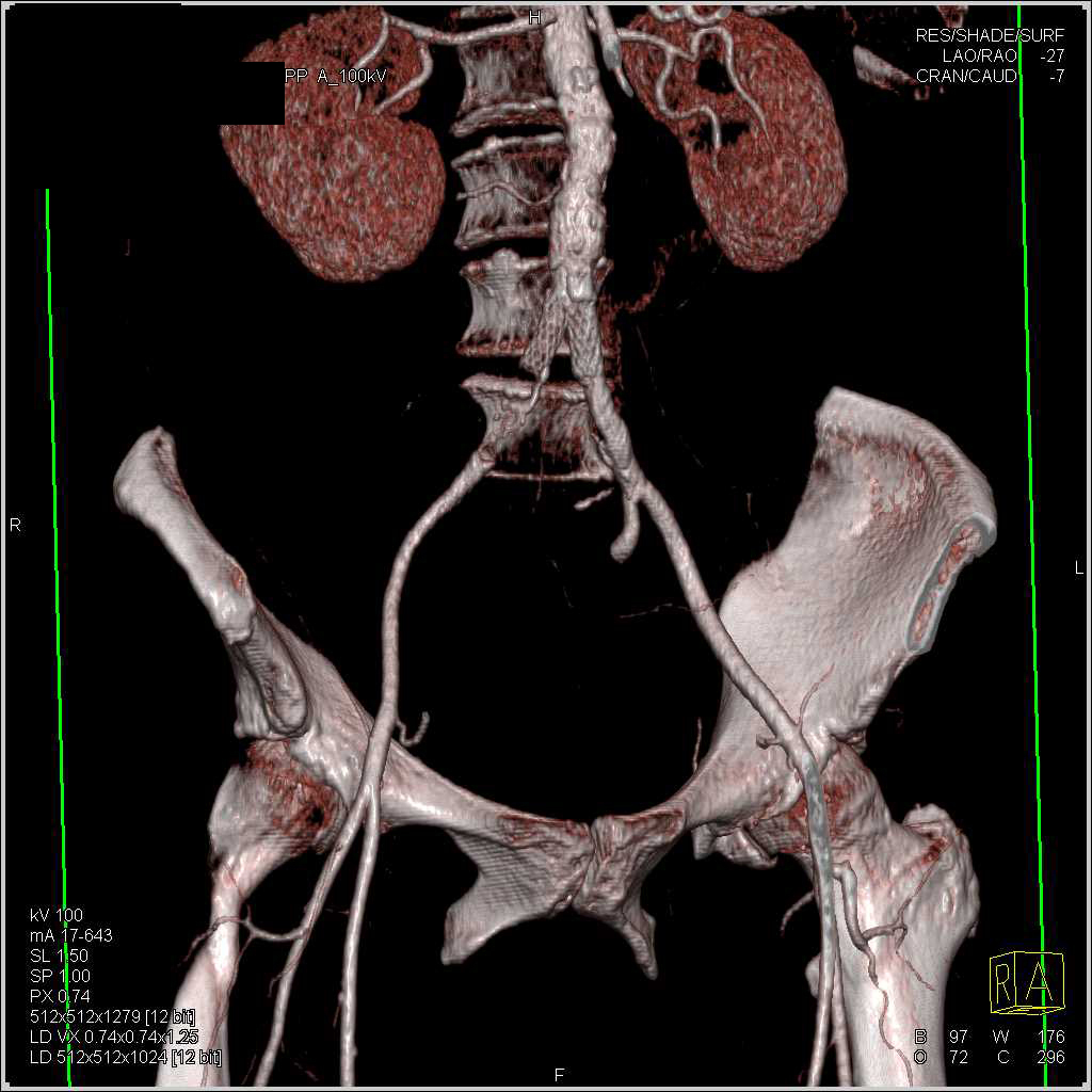 Right Common Iliac Artery Occlusion With Right Superf - vrogue.co