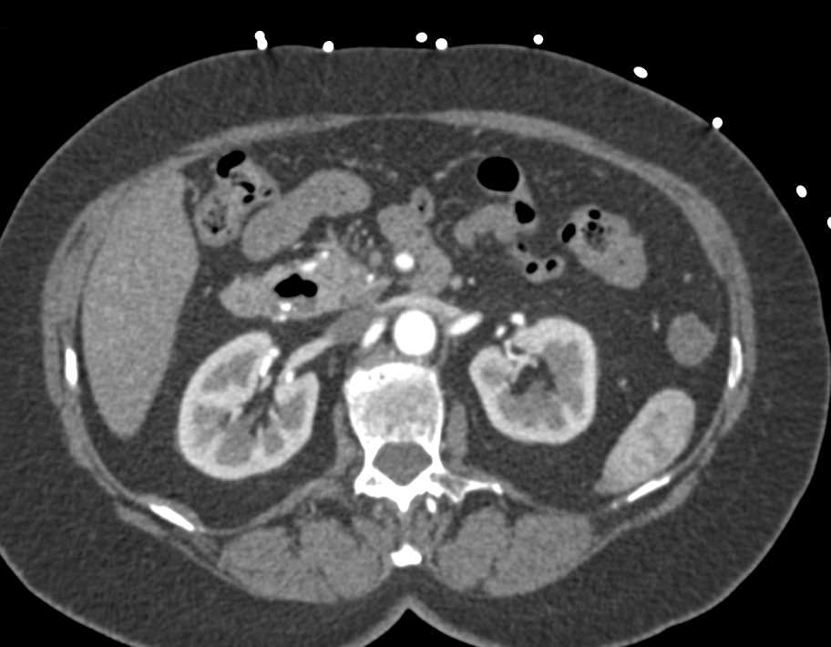 Celiac Occlusion with Collateral Flow through Gastroduodenal Artery (GDA) to Hepatic Artery - CTisus CT Scan