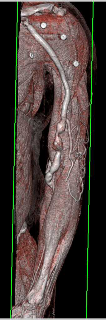 Arteriovenous (AV) Fistulae for Dialysis in Left Arm - CTisus CT Scan