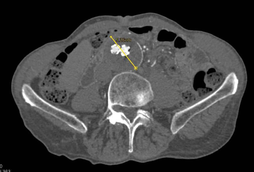 Stent in Popliteal Artery Aneurysm That is Occluded - CTisus CT Scan