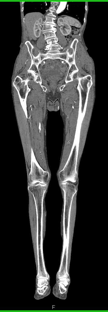 Peripheral Vascular Disease with Stents in Iliac Vessels - CTisus CT Scan