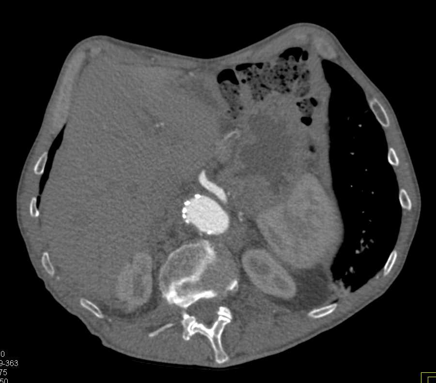 Peripheral Vascular Disease with Multiple Areas of Occlusion and Stenosis - CTisus CT Scan