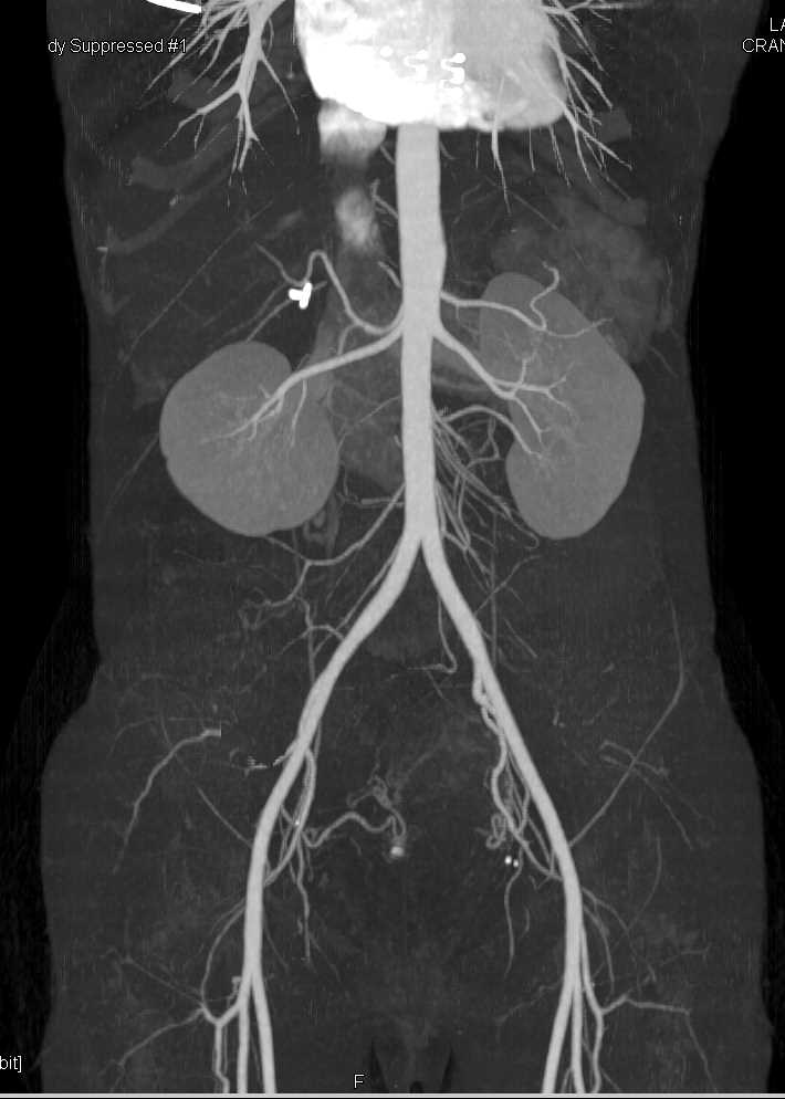 Normal CTA with Runoff with Normal Vasculature - CTisus CT Scan