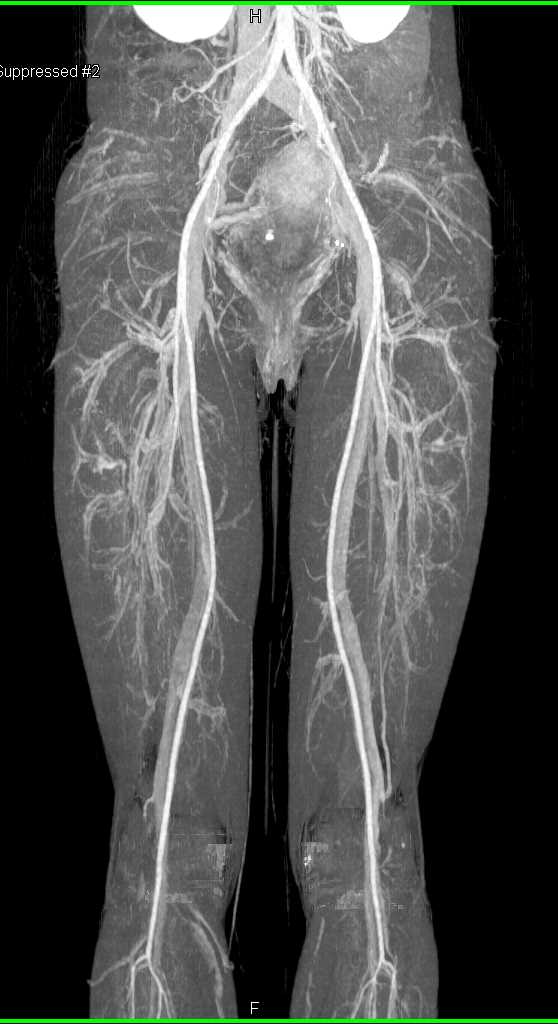 Normal CTA with Runoff with Normal Vasculature - Vascular Case Studies