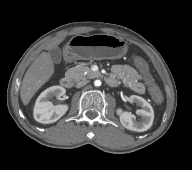 Stent Placed in Abdominal Aorta with Minimal Plaque - CTisus CT Scan