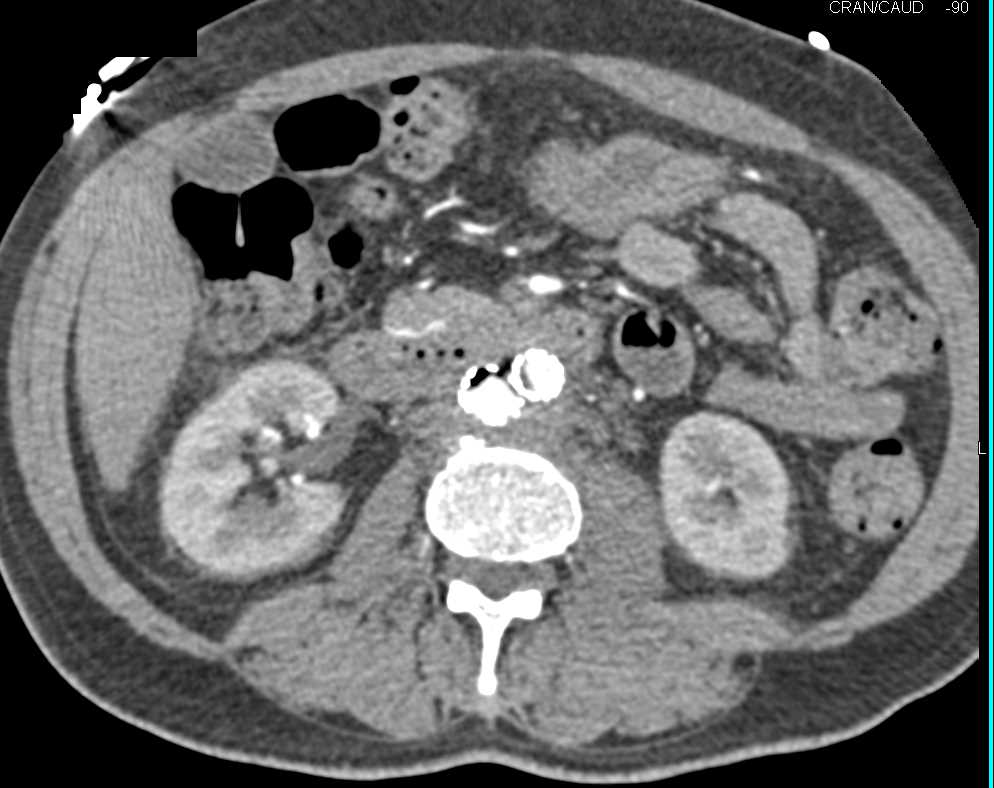 Infected Aortic Aneurysm Repair - CTisus CT Scan